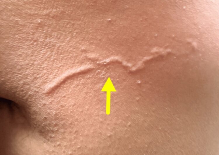 “등에 지렁이 모양 꿈틀”…가려움도 심하더니, 정체는 ‘기생충’?