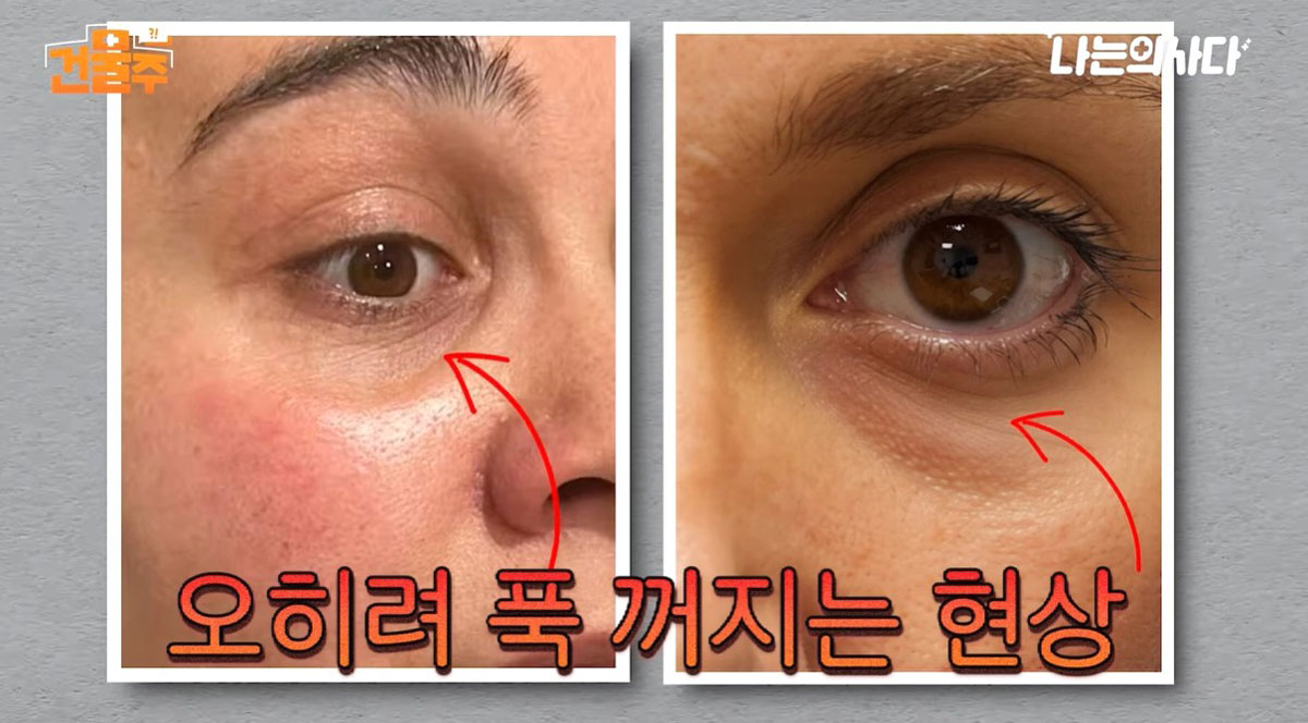 “눈밑지방, 무작정 제거하면 안 돼” 안과 의사가 알려주는 대처법